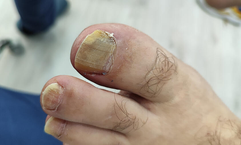 Onicomicosis