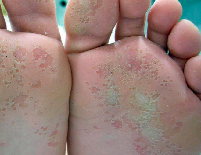 Dermatofitosis